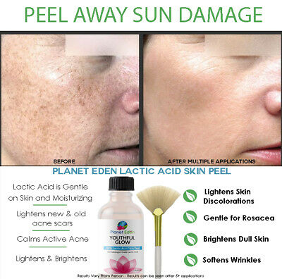 88% Lactic Acid Skin Face Chemical Peel Exfoliator - Pro Results From Home